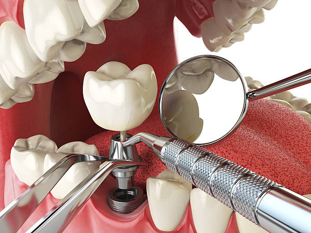 Best Emergency Tooth Extraction in Lexington, MO